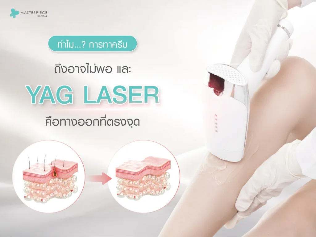 ทำไมการทาครีมถึงอาจไม่พอ และ YAG Laser คือทางออกที่ตรงจุด